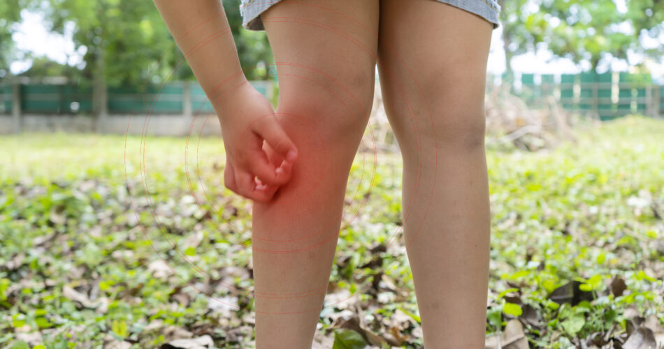 Asian girl has allergies with mosquitoes bite and itching her leg. Repellent, Dengue virus, Yellow fever, West nile, Malaria, Diseases Spread by Mosquitoes concept