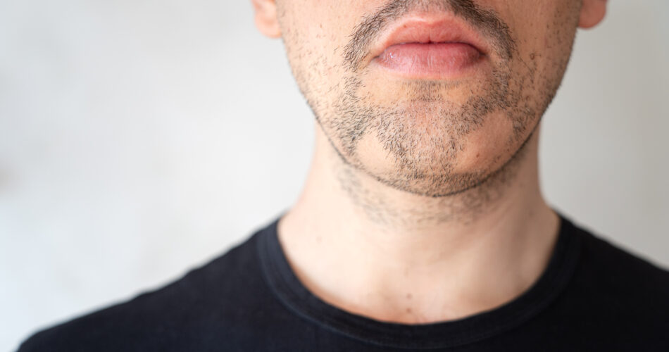 Alopecia areata on beard