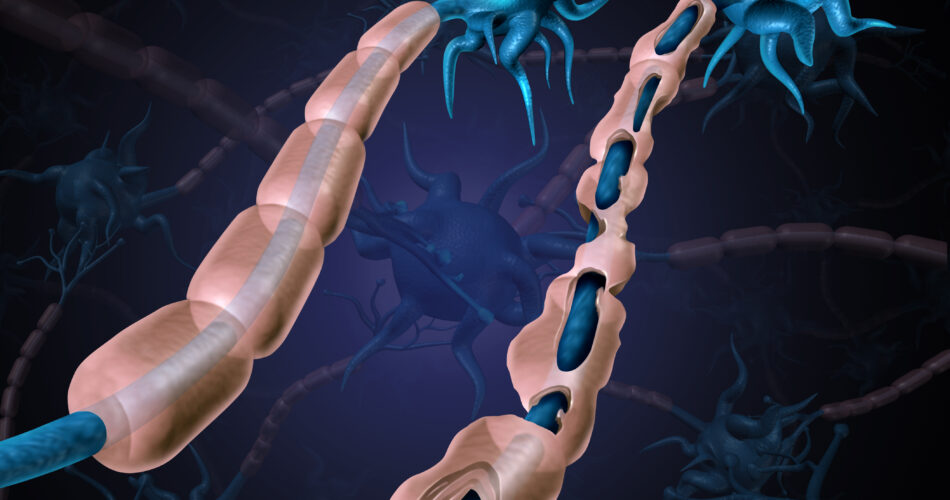 Multiple sclerosis damaged myelin or MS autoimmune disease with healthy nerve with exposed fibre with scarrred cell sheath loss as a 3D illustration.